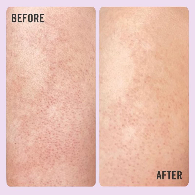 first aid kp bump eraser body scrub